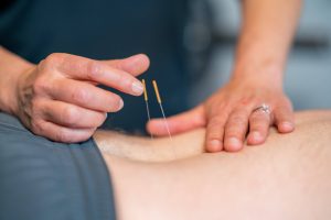 Dry Needling in Apache Junction, AZ